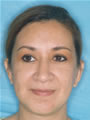 Brow Lift After picture