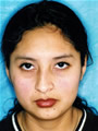 Nasal Sculpting Before picture