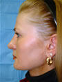 Nasal Sculpting After picture