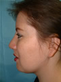Nasal Sculpting After picture