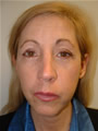 Nasal Sculpting Before picture