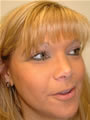 Nasal Sculpting After picture