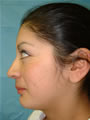Nasal Sculpting Before picture