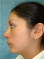 Nasal Sculpting After picture