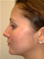 Nasal Sculpting After picture