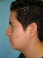 Nasal Sculpting After picture