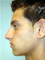 Nasal Sculpting Before picture