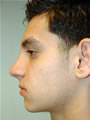 Nasal Sculpting After picture
