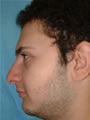 Nasal Sculpting Before picture