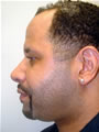Nasal Sculpting After picture