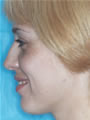 Nasal Sculpting Before picture