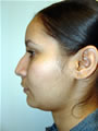 Nasal Sculpting Before picture