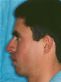 Nasal Sculpting Before picture