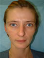 Nasal Sculpting and Fat Injection Before picture