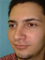 Nasal Sculpting After picture