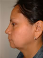 Nasal Sculpting After picture