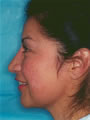 Nasal Sculpting and Chin Liposuction After picture