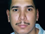 Otoplasty After picture